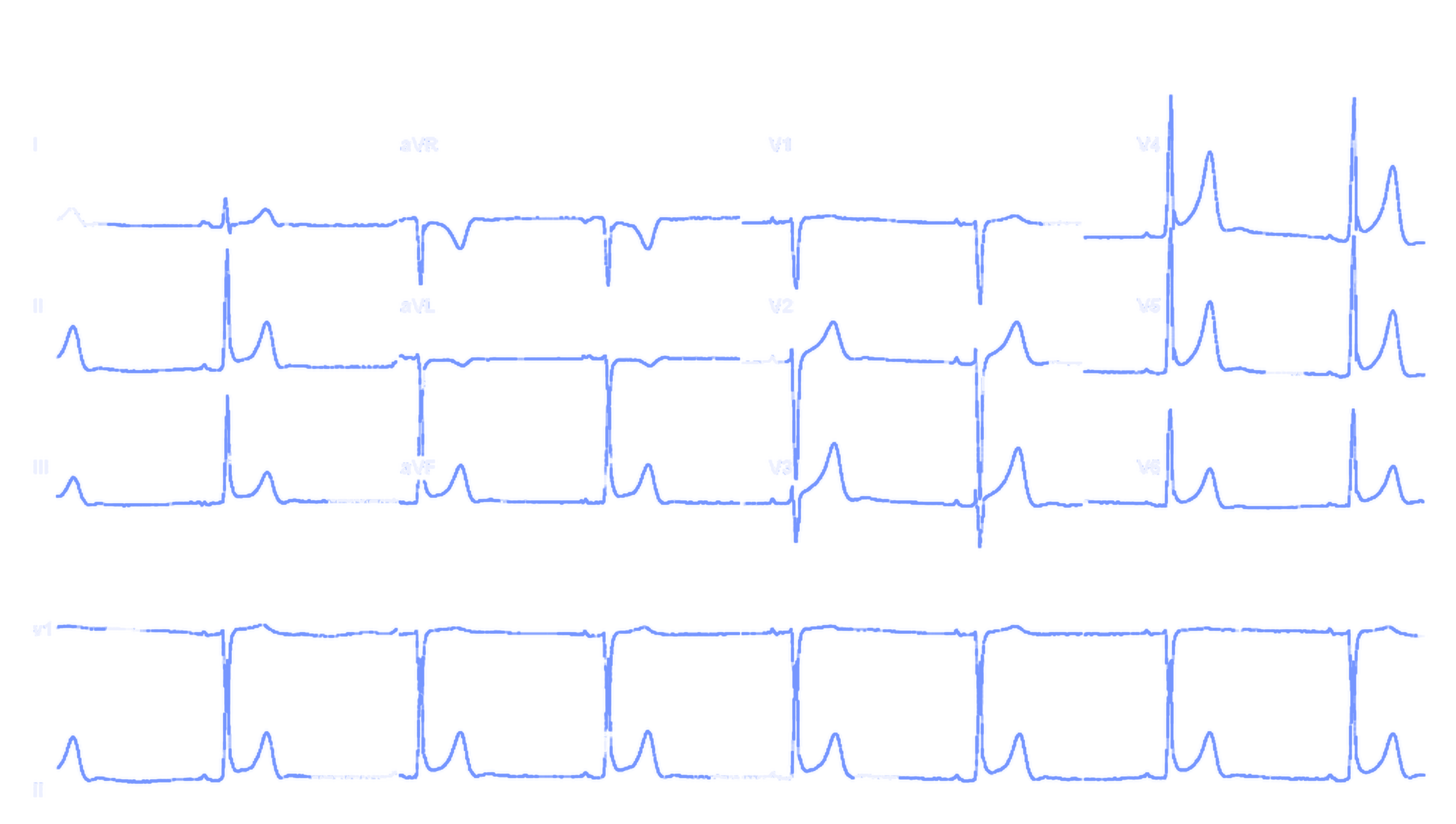 The same ECG reconstructed as digital traces for each lead, with the grid removed.