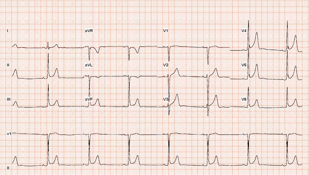 Printed 12-lead resting ECG on red grid paper in a 3×4 layout with V1 and II rhythm strips.